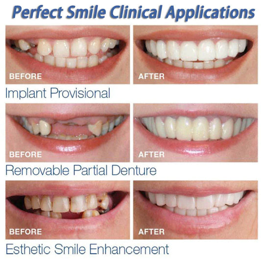 Instant Perfect Smile Dental Veneers